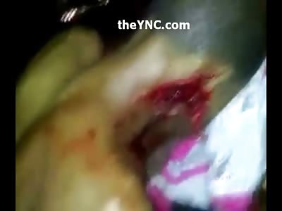 Young Boy will never Look the Same...Neck Gaping Open from Machete Beating 