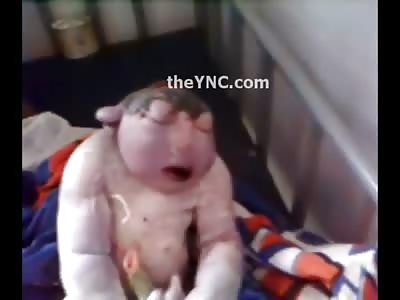Sad Video of Large Baby in his Crib, Born with Disfiguring Disease