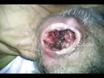 Hole Filled with Maggots in this Elderly Dudes Jaw is Beyond Gross