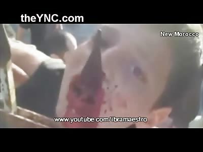 Little Kid Impaled on Fence Through his Mouth....OUCH!!!