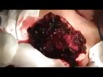 Doctors Remove Coagulated Blood from Mans Chest with a Horrible Infection 