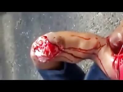 Twisted Leg and Fucked up Knee Cap