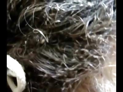 Woman with a Terrible Case of Head Lice is Just Disgusting 
