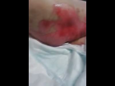 Man with Horribly Painful Skin Disease Squirms in his Hospital Bed 