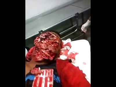 Different Much Better Quality Video of Mans Face Hacked up with a Machete .. Doctors Laughing in the Background