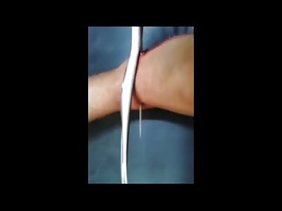 Stingray Barb Removed from Man's Ankle