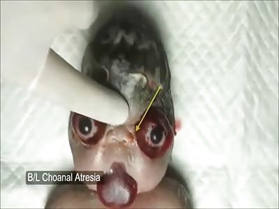 Very Sad and Disturbing Video of Horrifically Deformed Baby