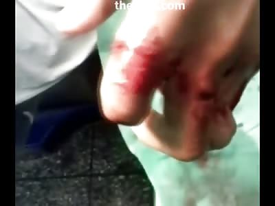 Worker with Horribly and Painful Broken Fingers 