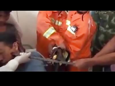 Man With a Metal Rod Stuck Through his Face is Frantically Operated on