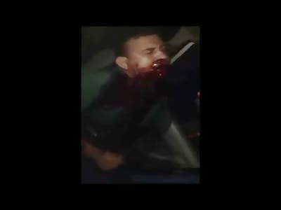Man in Agony after Being Shot in the Face .. Non-Stop Bleeding