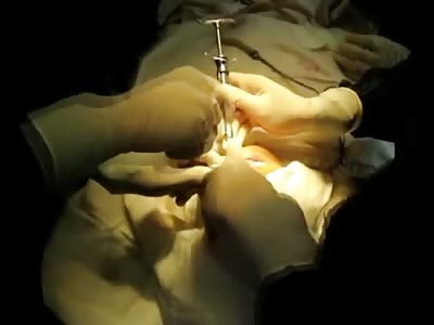 Woman with Huge Disgusting Tumor in her Mouth get its Removed