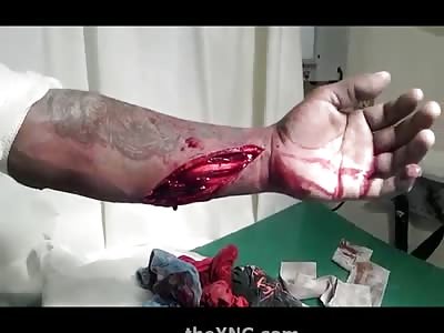 Tendons in the Arm Exposed after Cut Opens Man's Forearm
