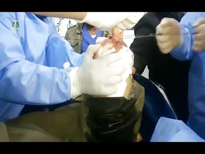 Short Gruesome Video of Doctors Sawing off a Man's Leg 