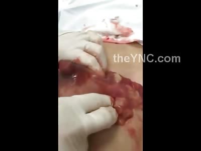 GROSS: Woman has Puss Removed from Her Breast