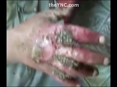 Wash your Hands and Clean off Bacteria or Maggots will Infest It like this Man's Disgusting Hand 