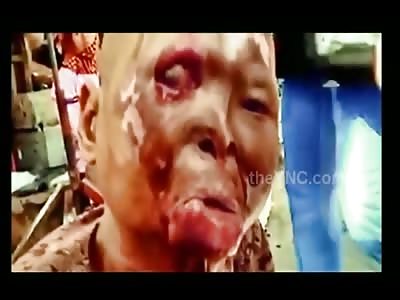 Woman Horribly Disfigured from an Acid Attack