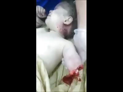 Scared ArmLess Baby Cries in Hospital 