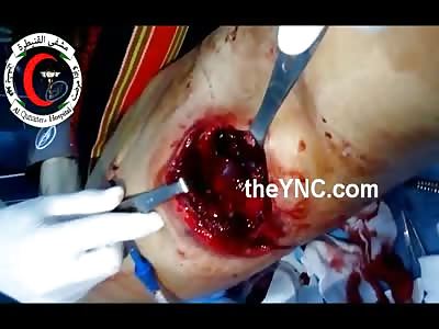 Huge Hole in Mans Side Shows his Insides Moving