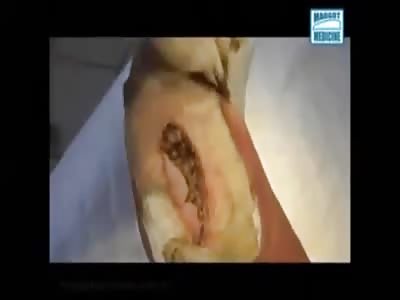 Treating Wounds with Maggots ... Would You do That?