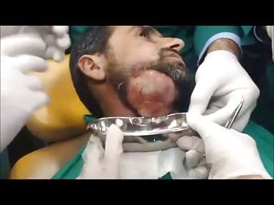 Draining a large abscess from a man's face