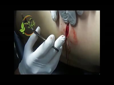 Removing a Bullet Stuck in a Man's Thorax