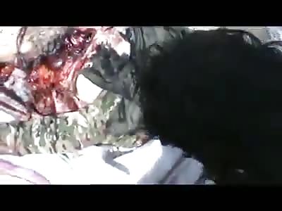 Suicide Bomber with Huge Chest Wound
