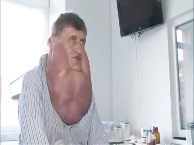 Man has giant six kilogramme tumour removed from his face