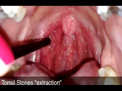 Tonsil stones