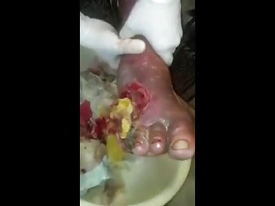 Disgusting Foot Fungus is Turning All Types of Colors 