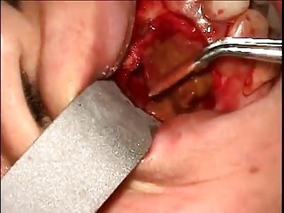 Pus filled lesion in mouth.