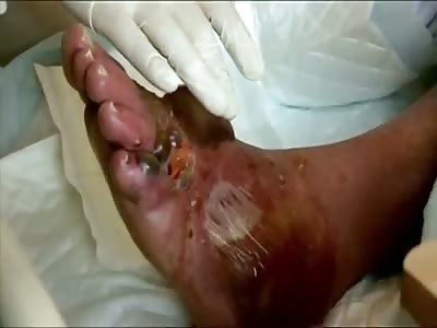 Huge pus filled blisters on old guy's foot!