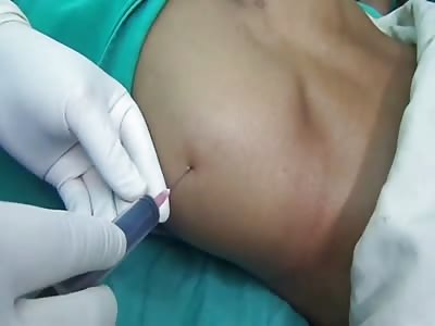 Incision and Drainage of a Huge Abscess.