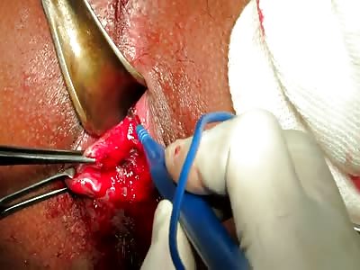Bleeding piles resection by harmonic shears.
