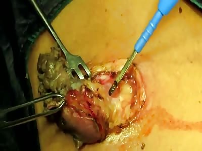 Excision of nasty pus filled cyst!