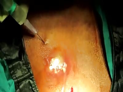 Cyst excision, drainage.