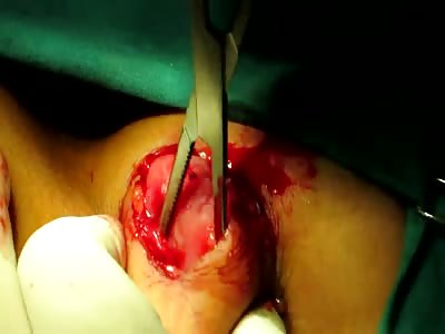 Excision of bilateral fibroadenoma from big boobie!