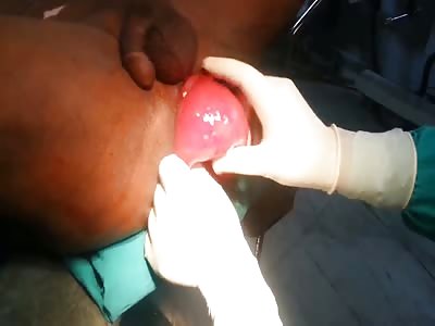 Rectal prolapse or fun with water balloons?