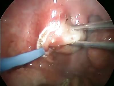 Tonsil stones removal.