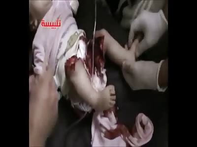 Babies Legs are Fucked Up after Bombing