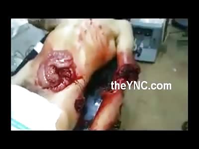 Dudes Intestines Falling Out