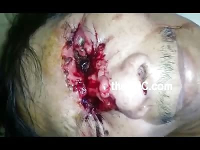 Man With Horrible Eye Wound Full of Maggots