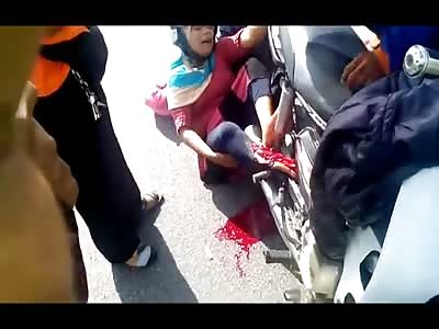 Woman in Agony with Lower Leg Crushed by Scooter