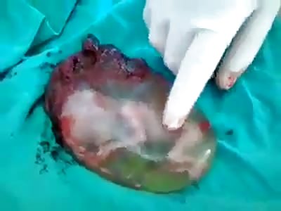 amazing! Live fetus outside the uterus