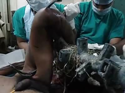 A RARE FOREIGN BODY IN LEG REMOVED