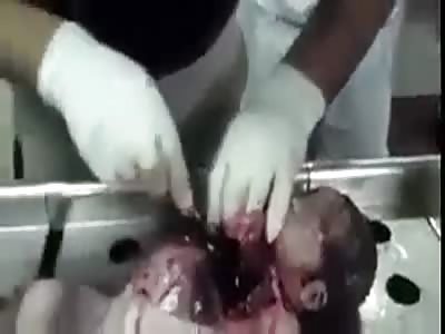 Baby autopsy