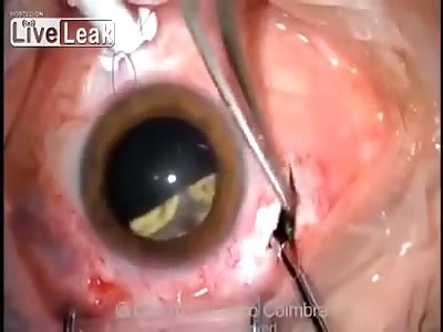 SHARD OF GLASS REMOVED FROM EYEBALL