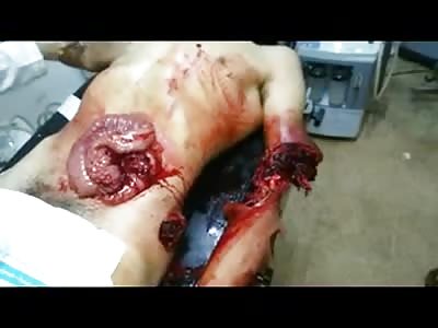 MAN WITH EXPOSED GUTS AND SHATTERED ARM 