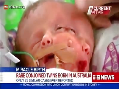 Very rare baby is born with two faces in Sydney,Australia.